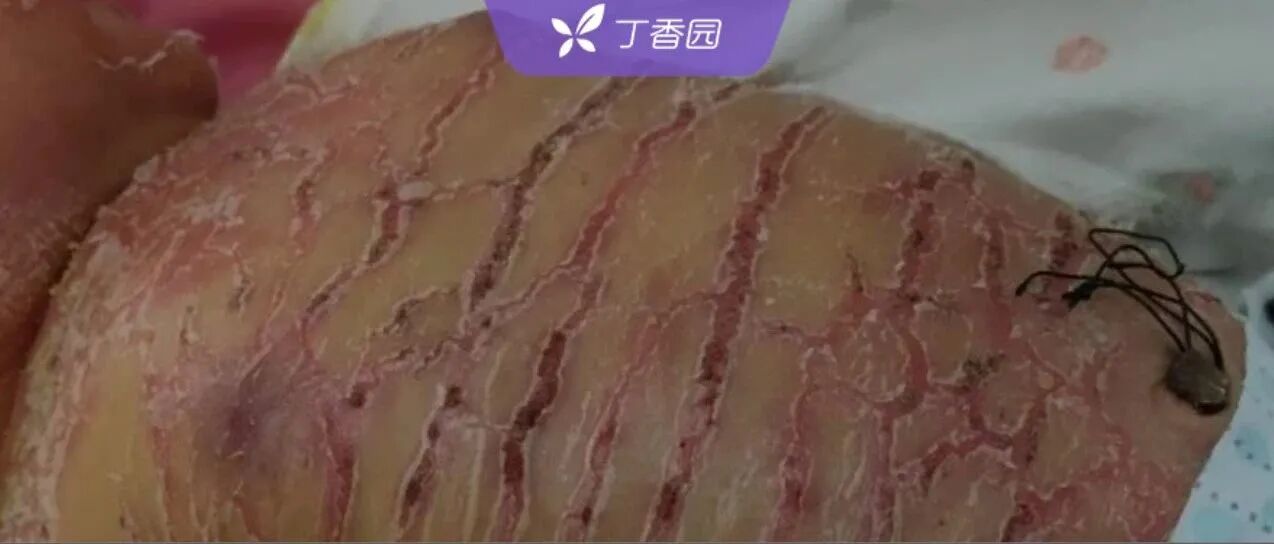 新生儿全身皲裂成「鳄鱼皮」，究竟是什么病？