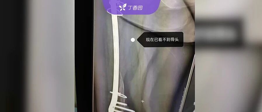 右股骨莫名溶解消失，患者：我愿把自己当人体研究