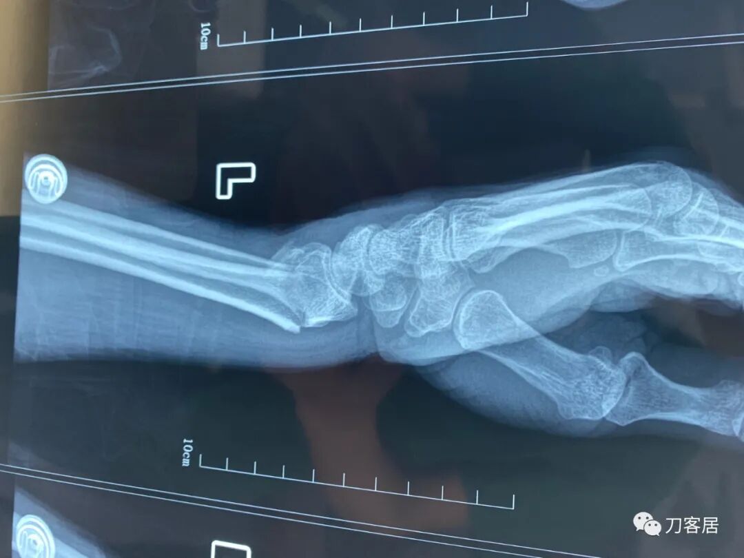 聚酯石膏怎么打6岁孩子的尺桡骨双骨折，就给手术了？外固定架外面还打石膏？_https://www.jmylbn.com_新闻资讯_第33张