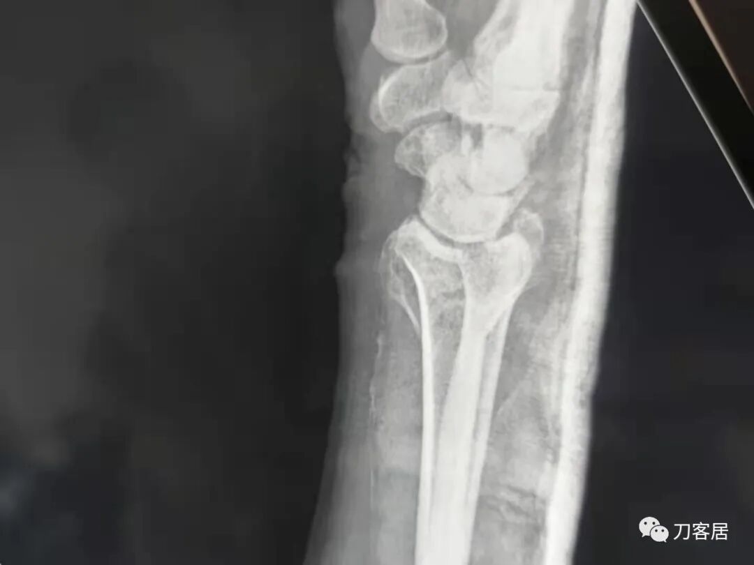 聚酯石膏怎么打6岁孩子的尺桡骨双骨折，就给手术了？外固定架外面还打石膏？_https://www.jmylbn.com_新闻资讯_第47张