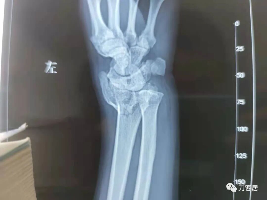 聚酯石膏怎么打6岁孩子的尺桡骨双骨折，就给手术了？外固定架外面还打石膏？_https://www.jmylbn.com_新闻资讯_第46张