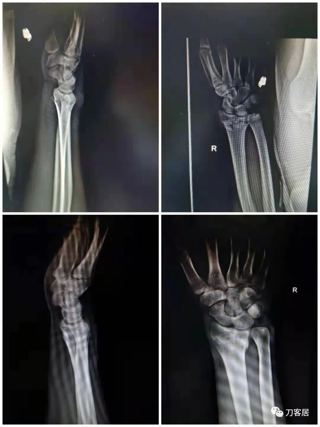 聚酯石膏怎么打6岁孩子的尺桡骨双骨折，就给手术了？外固定架外面还打石膏？_https://www.jmylbn.com_新闻资讯_第28张