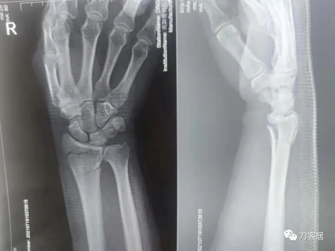 聚酯石膏怎么打6岁孩子的尺桡骨双骨折，就给手术了？外固定架外面还打石膏？_https://www.jmylbn.com_新闻资讯_第42张