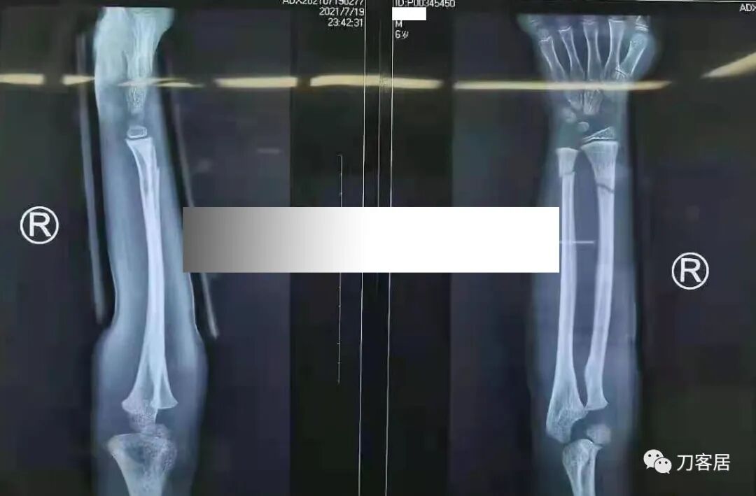 聚酯石膏怎么打6岁孩子的尺桡骨双骨折，就给手术了？外固定架外面还打石膏？_https://www.jmylbn.com_新闻资讯_第9张