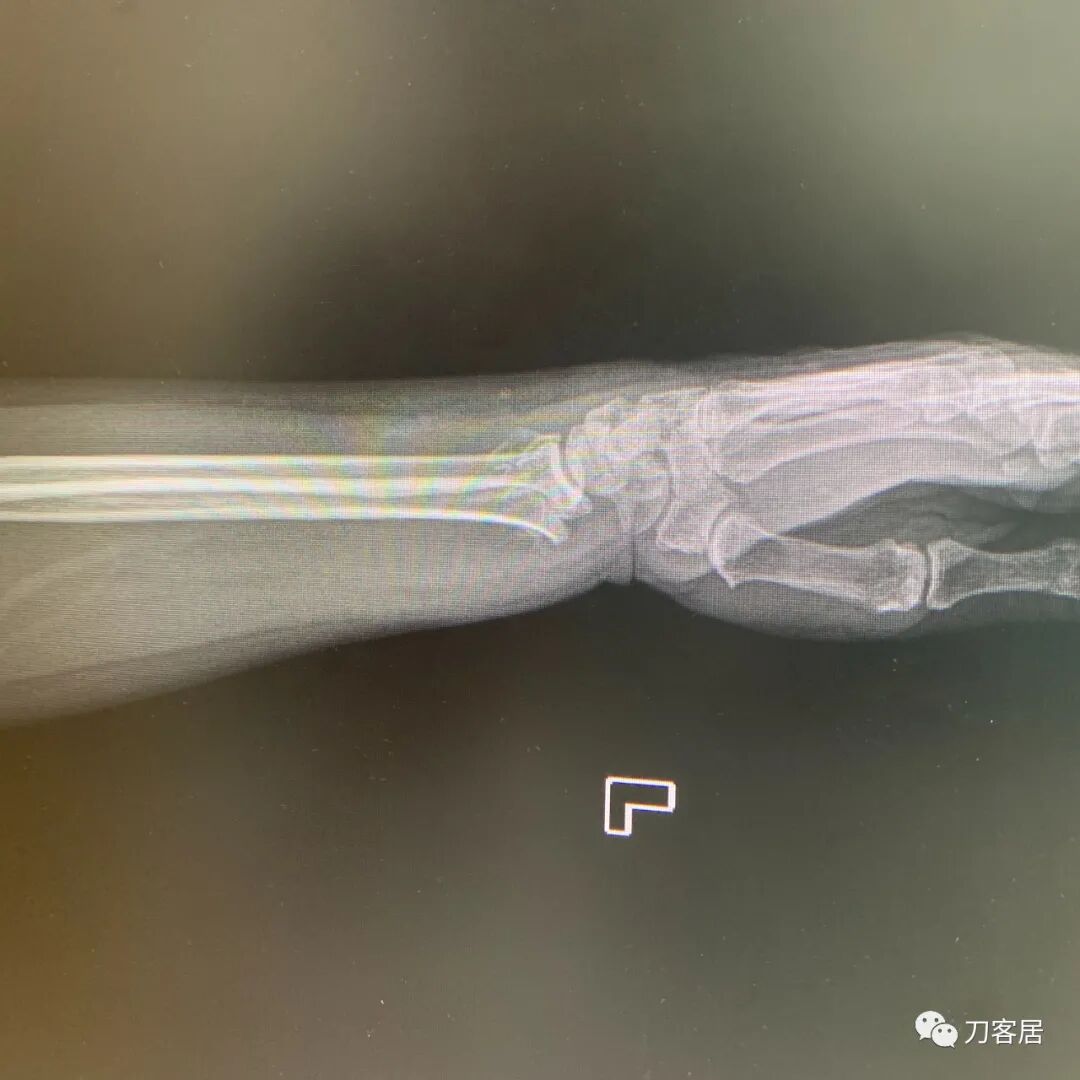 聚酯石膏怎么打6岁孩子的尺桡骨双骨折，就给手术了？外固定架外面还打石膏？_https://www.jmylbn.com_新闻资讯_第37张