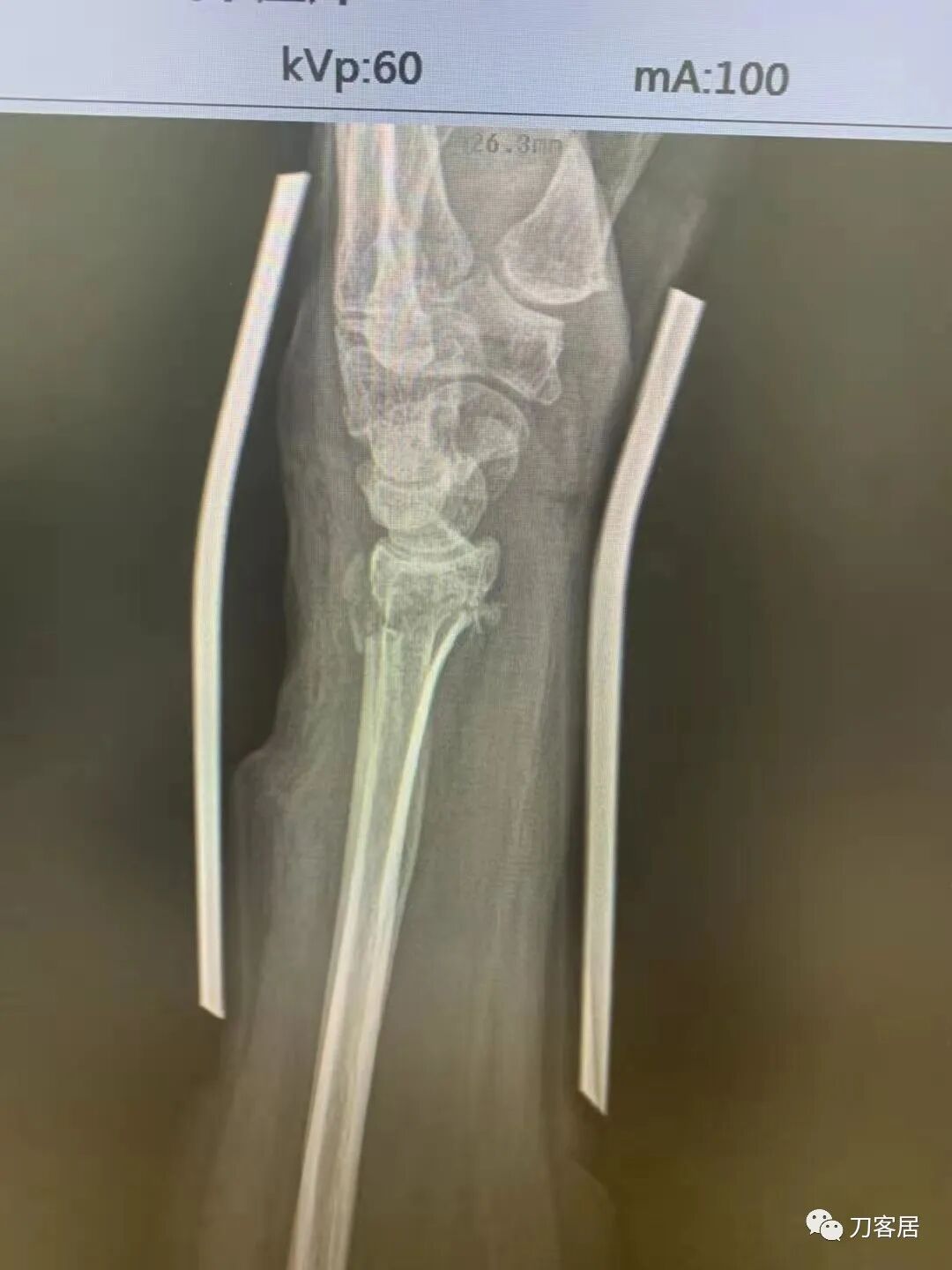 聚酯石膏怎么打6岁孩子的尺桡骨双骨折，就给手术了？外固定架外面还打石膏？_https://www.jmylbn.com_新闻资讯_第43张