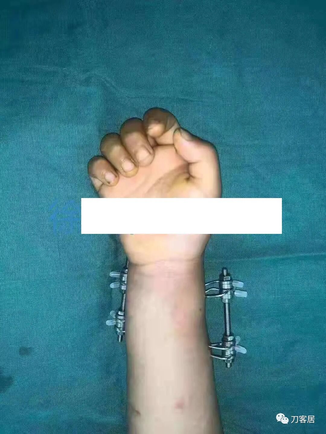 聚酯石膏怎么打6岁孩子的尺桡骨双骨折，就给手术了？外固定架外面还打石膏？_https://www.jmylbn.com_新闻资讯_第11张