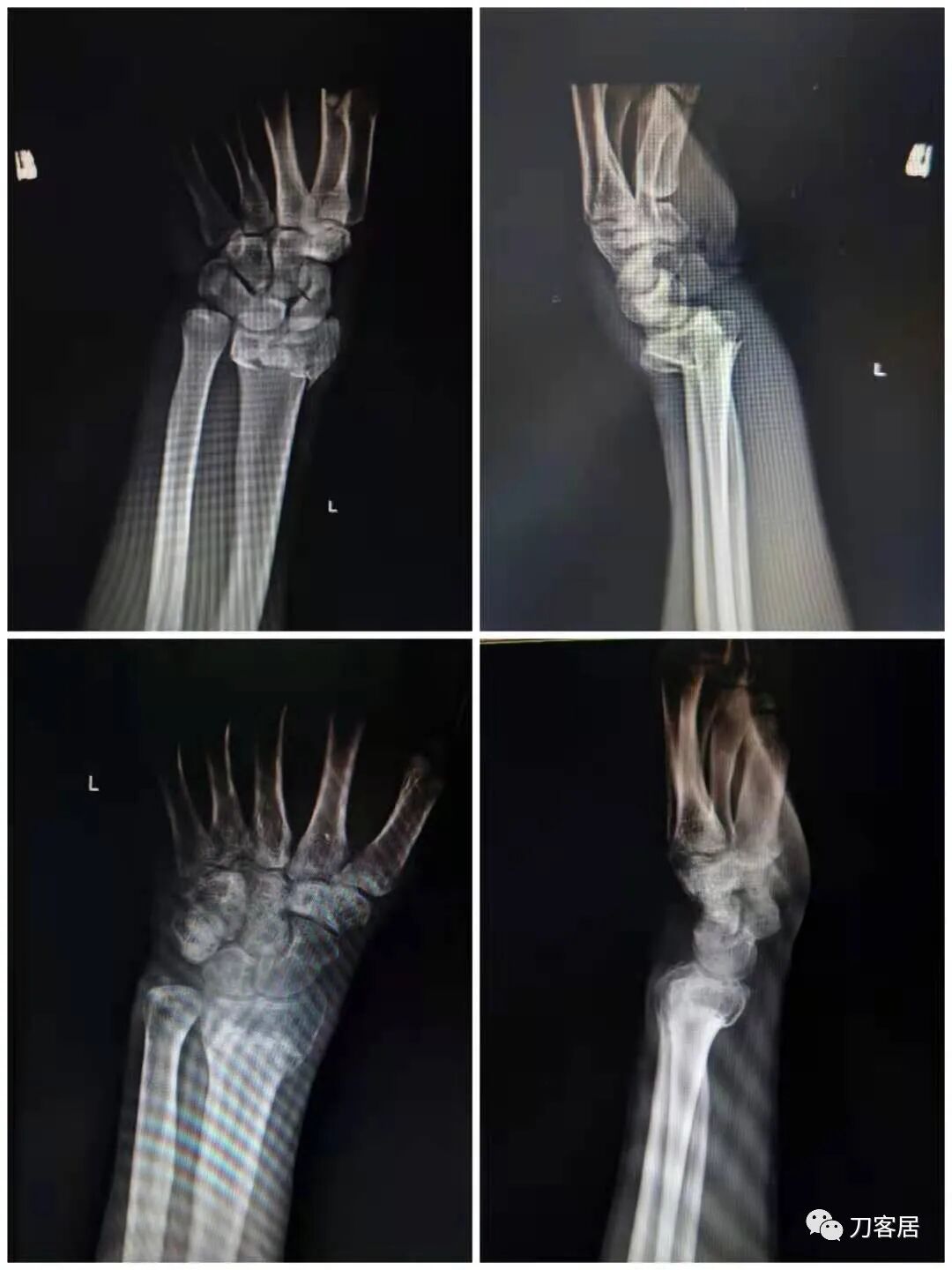 聚酯石膏怎么打6岁孩子的尺桡骨双骨折，就给手术了？外固定架外面还打石膏？_https://www.jmylbn.com_新闻资讯_第27张