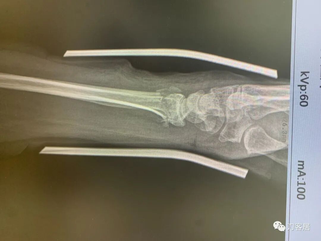 聚酯石膏怎么打6岁孩子的尺桡骨双骨折，就给手术了？外固定架外面还打石膏？_https://www.jmylbn.com_新闻资讯_第38张