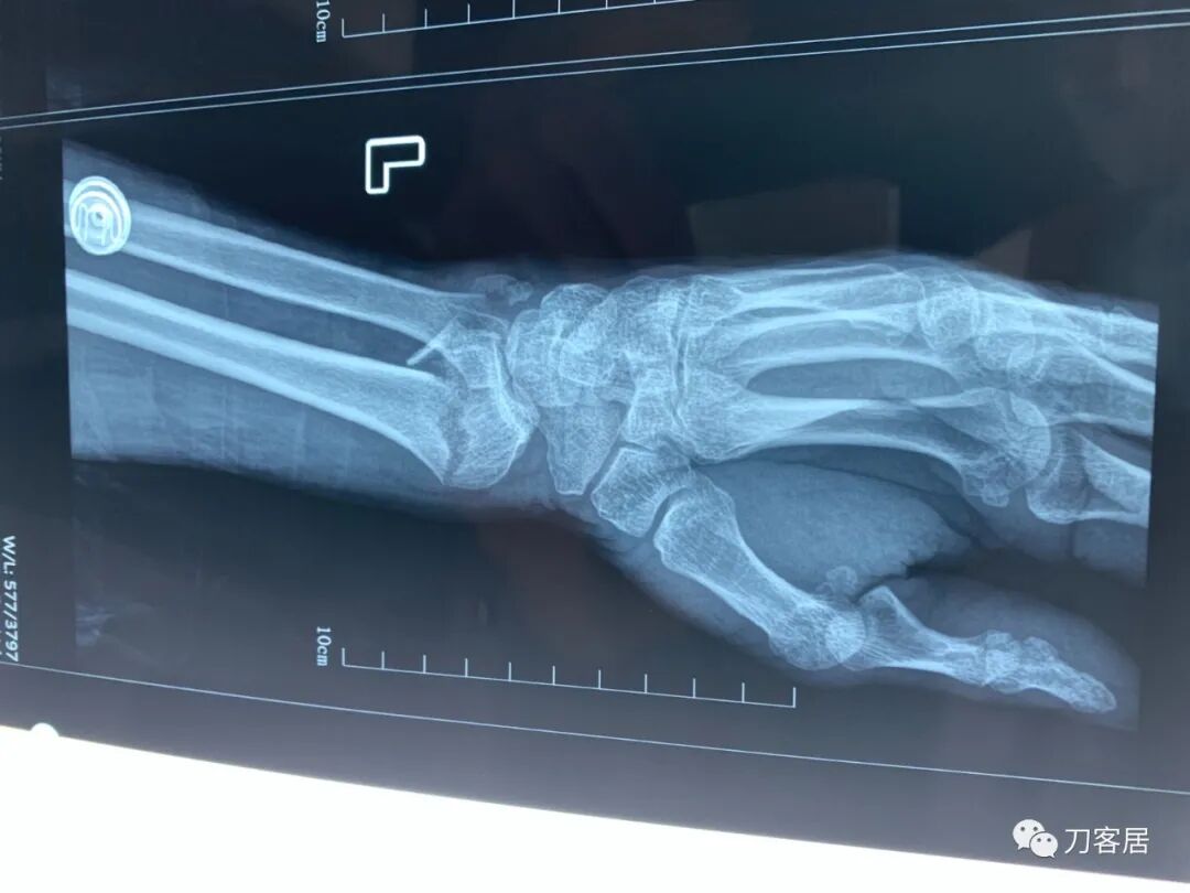 聚酯石膏怎么打6岁孩子的尺桡骨双骨折，就给手术了？外固定架外面还打石膏？_https://www.jmylbn.com_新闻资讯_第32张