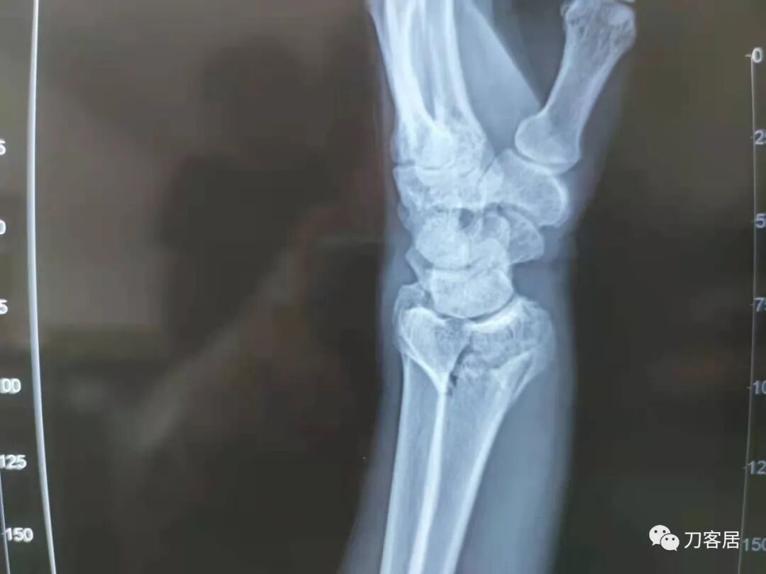 聚酯石膏怎么打6岁孩子的尺桡骨双骨折，就给手术了？外固定架外面还打石膏？_https://www.jmylbn.com_新闻资讯_第45张