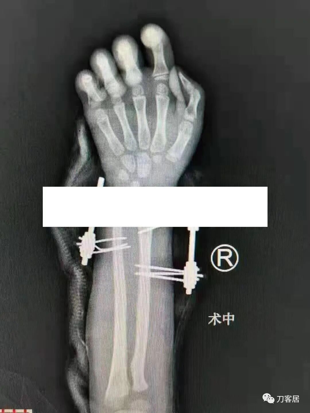 聚酯石膏怎么打6岁孩子的尺桡骨双骨折，就给手术了？外固定架外面还打石膏？_https://www.jmylbn.com_新闻资讯_第10张