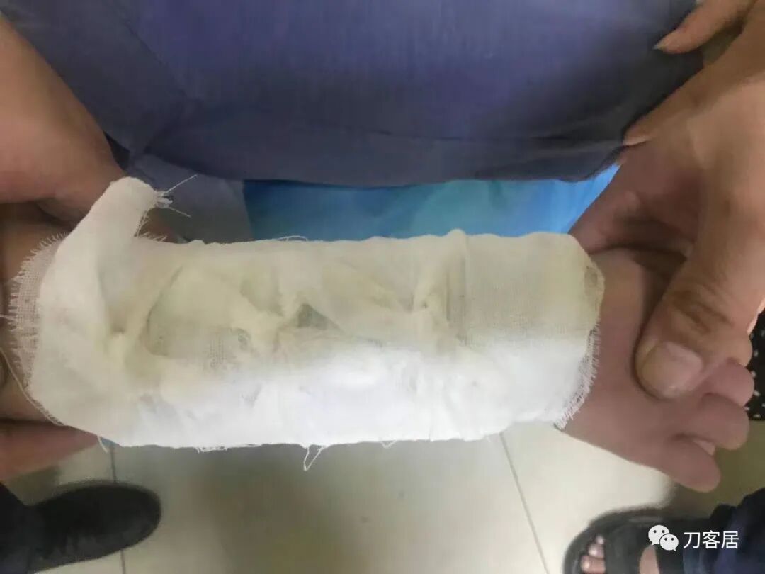 聚酯石膏怎么打6岁孩子的尺桡骨双骨折，就给手术了？外固定架外面还打石膏？_https://www.jmylbn.com_新闻资讯_第31张