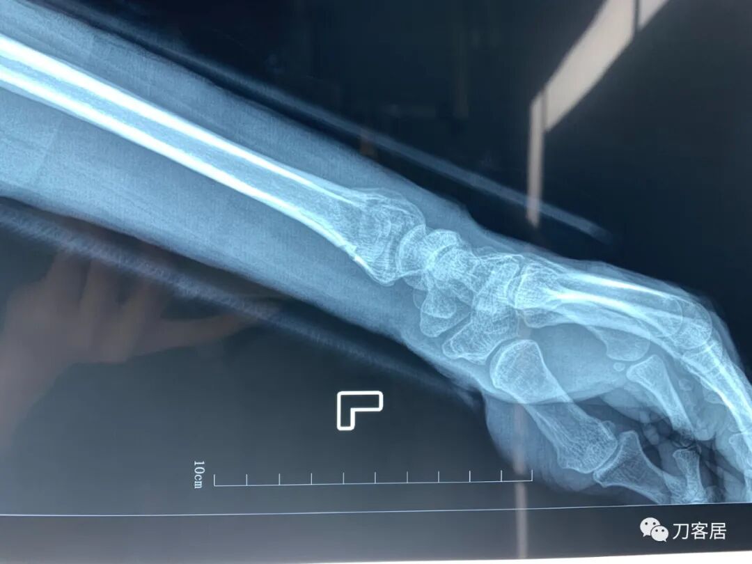 聚酯石膏怎么打6岁孩子的尺桡骨双骨折，就给手术了？外固定架外面还打石膏？_https://www.jmylbn.com_新闻资讯_第34张