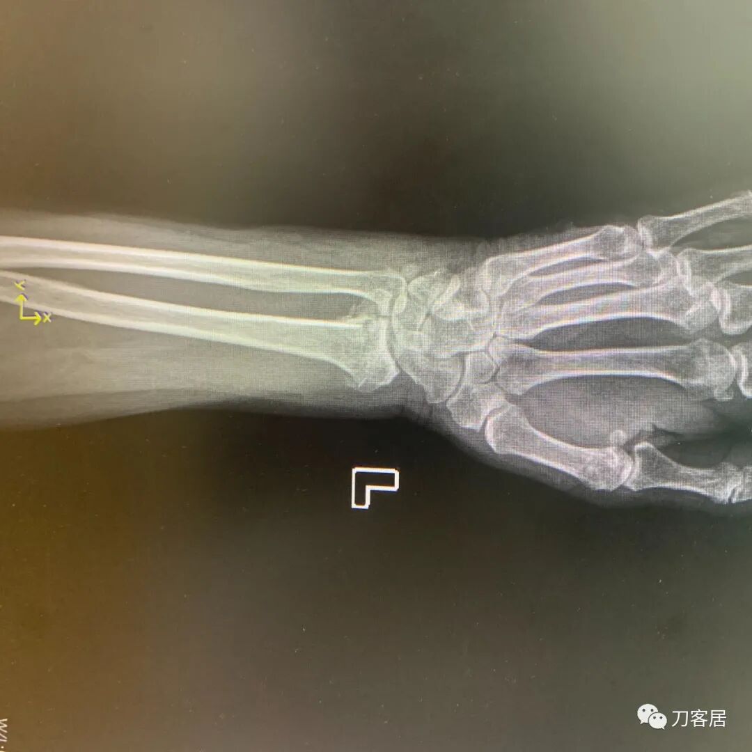 聚酯石膏怎么打6岁孩子的尺桡骨双骨折，就给手术了？外固定架外面还打石膏？_https://www.jmylbn.com_新闻资讯_第36张