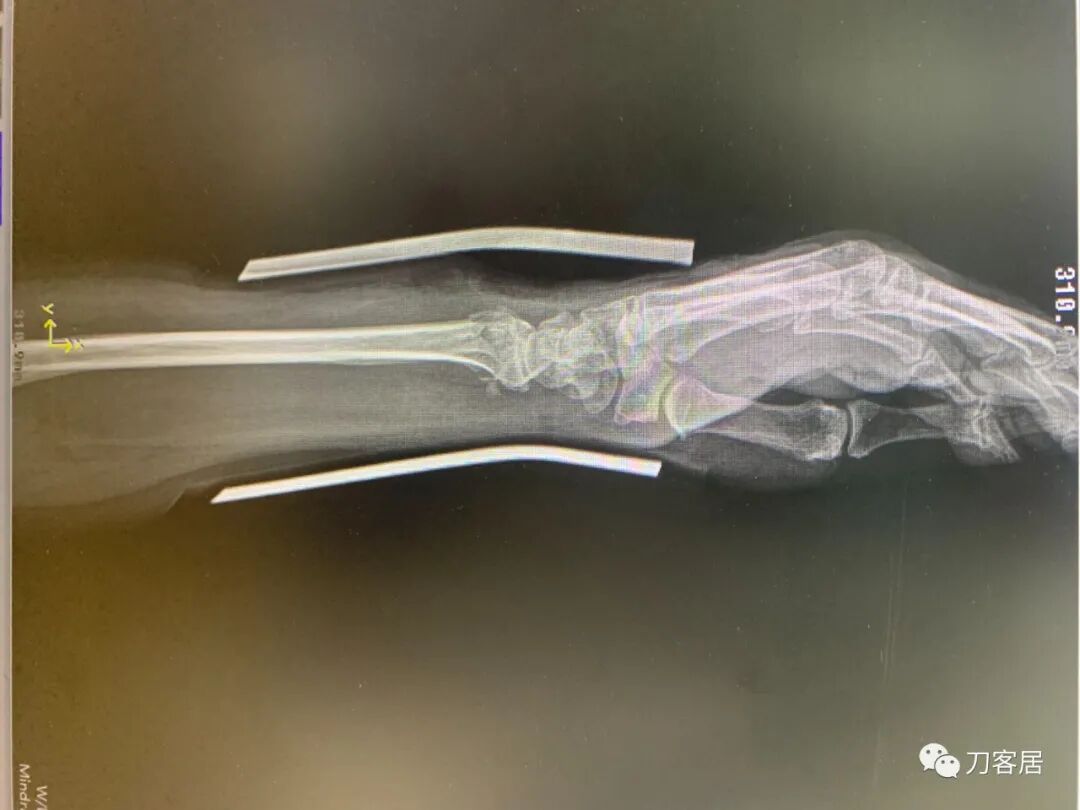 聚酯石膏怎么打6岁孩子的尺桡骨双骨折，就给手术了？外固定架外面还打石膏？_https://www.jmylbn.com_新闻资讯_第39张