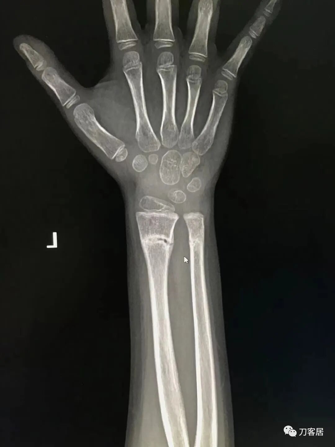 聚酯石膏怎么打6岁孩子的尺桡骨双骨折，就给手术了？外固定架外面还打石膏？_https://www.jmylbn.com_新闻资讯_第24张