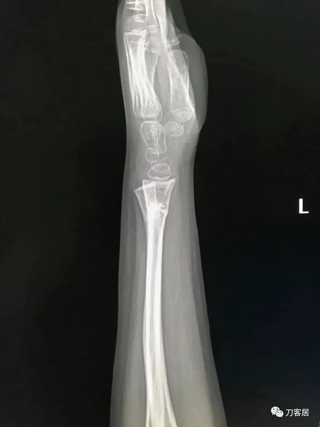 聚酯石膏怎么打6岁孩子的尺桡骨双骨折，就给手术了？外固定架外面还打石膏？_https://www.jmylbn.com_新闻资讯_第25张