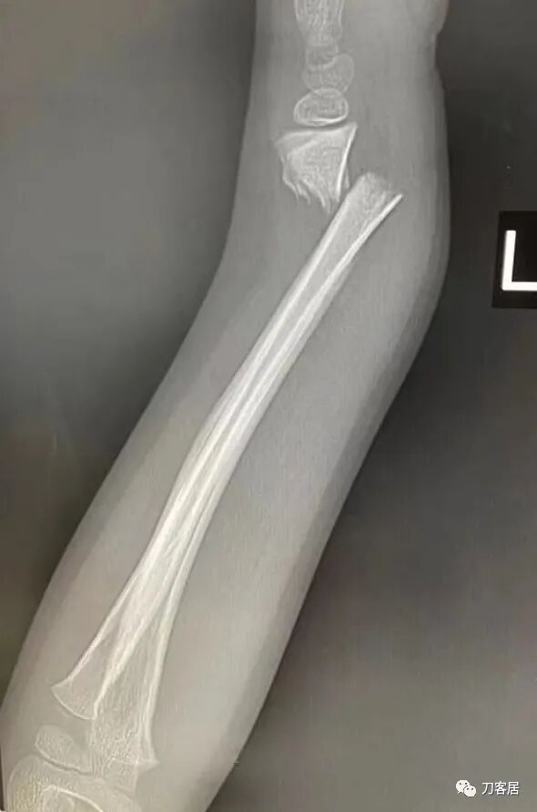 聚酯石膏怎么打6岁孩子的尺桡骨双骨折，就给手术了？外固定架外面还打石膏？_https://www.jmylbn.com_新闻资讯_第23张