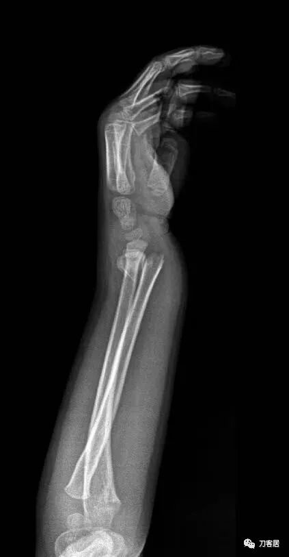聚酯石膏怎么打6岁孩子的尺桡骨双骨折，就给手术了？外固定架外面还打石膏？_https://www.jmylbn.com_新闻资讯_第62张