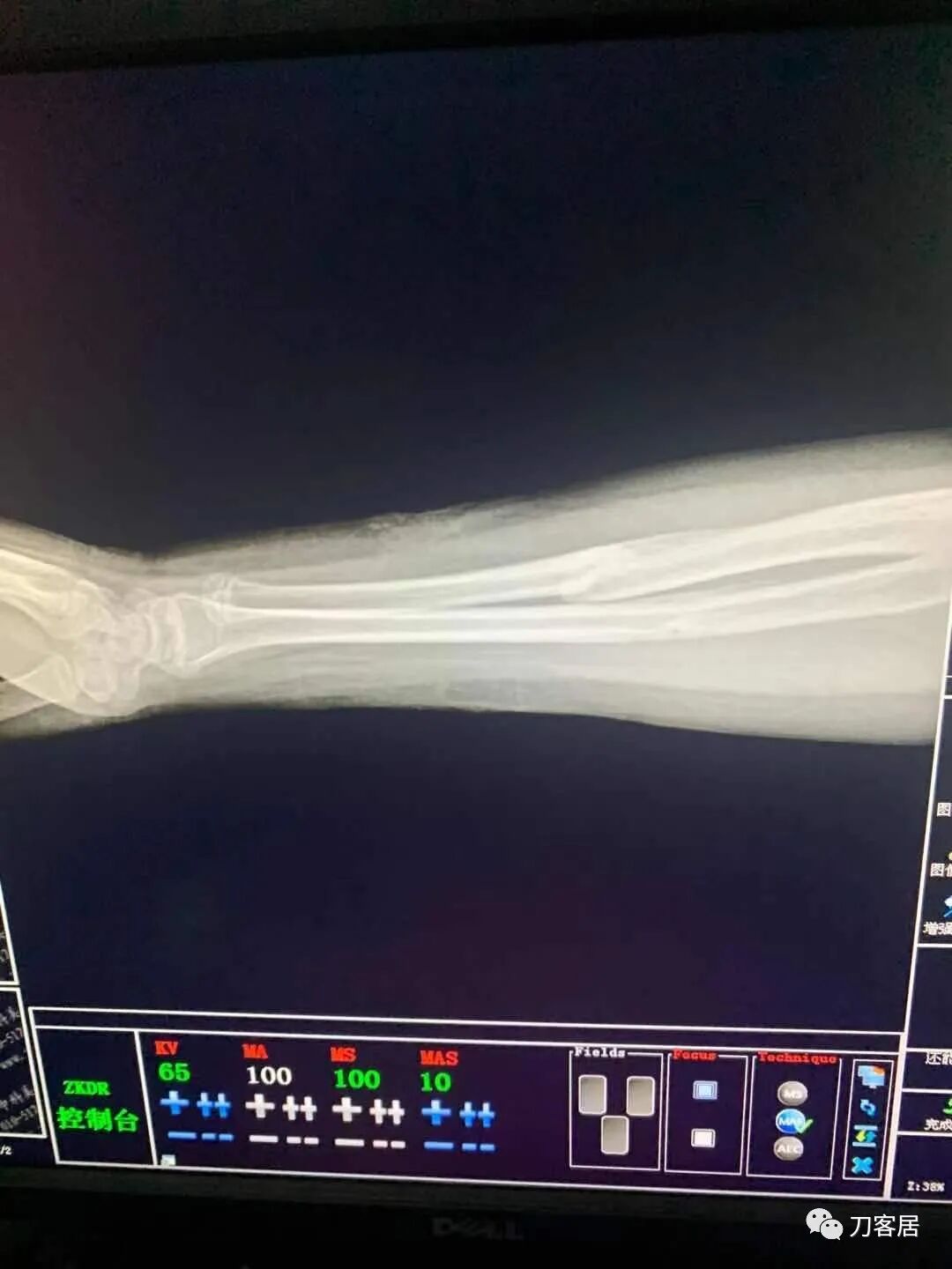 聚酯石膏怎么打6岁孩子的尺桡骨双骨折，就给手术了？外固定架外面还打石膏？_https://www.jmylbn.com_新闻资讯_第74张