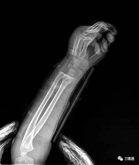 聚酯石膏怎么打6岁孩子的尺桡骨双骨折，就给手术了？外固定架外面还打石膏？_https://www.jmylbn.com_新闻资讯_第66张