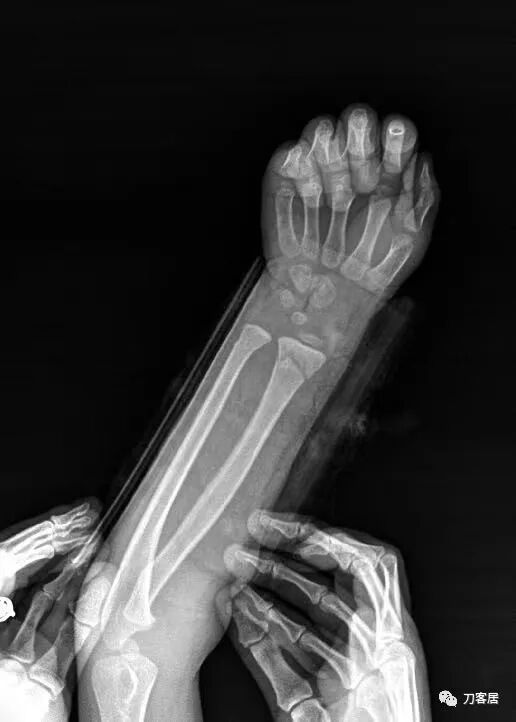 聚酯石膏怎么打6岁孩子的尺桡骨双骨折，就给手术了？外固定架外面还打石膏？_https://www.jmylbn.com_新闻资讯_第65张