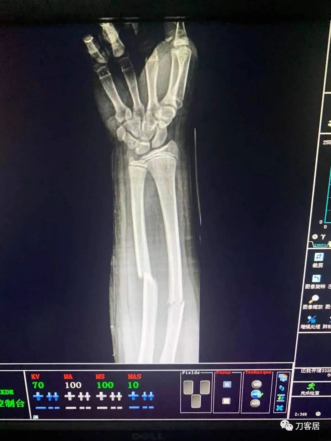 聚酯石膏怎么打6岁孩子的尺桡骨双骨折，就给手术了？外固定架外面还打石膏？_https://www.jmylbn.com_新闻资讯_第72张