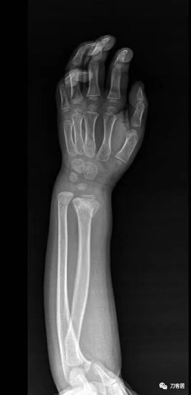 聚酯石膏怎么打6岁孩子的尺桡骨双骨折，就给手术了？外固定架外面还打石膏？_https://www.jmylbn.com_新闻资讯_第61张