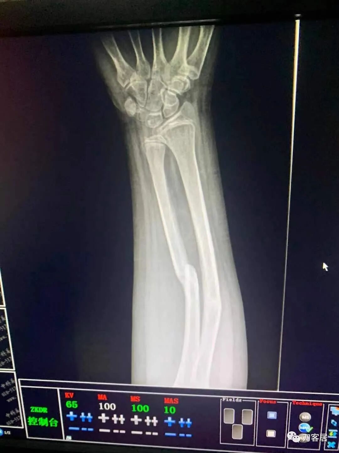 聚酯石膏怎么打6岁孩子的尺桡骨双骨折，就给手术了？外固定架外面还打石膏？_https://www.jmylbn.com_新闻资讯_第73张