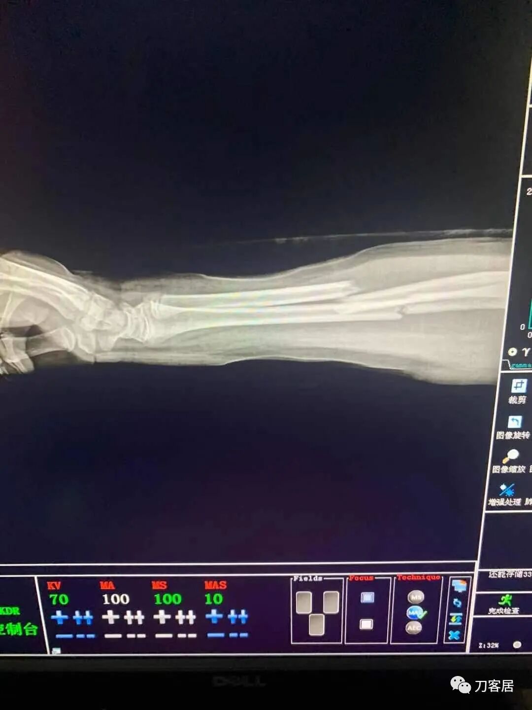 聚酯石膏怎么打6岁孩子的尺桡骨双骨折，就给手术了？外固定架外面还打石膏？_https://www.jmylbn.com_新闻资讯_第71张