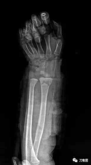 聚酯石膏怎么打6岁孩子的尺桡骨双骨折，就给手术了？外固定架外面还打石膏？_https://www.jmylbn.com_新闻资讯_第64张