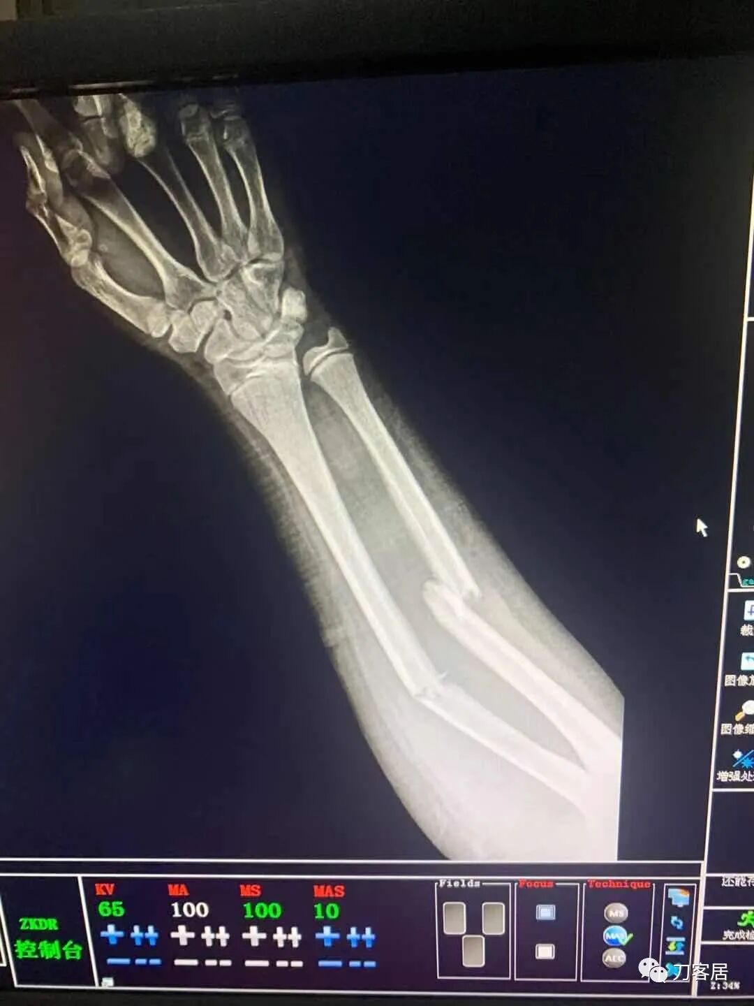 聚酯石膏怎么打6岁孩子的尺桡骨双骨折，就给手术了？外固定架外面还打石膏？_https://www.jmylbn.com_新闻资讯_第69张