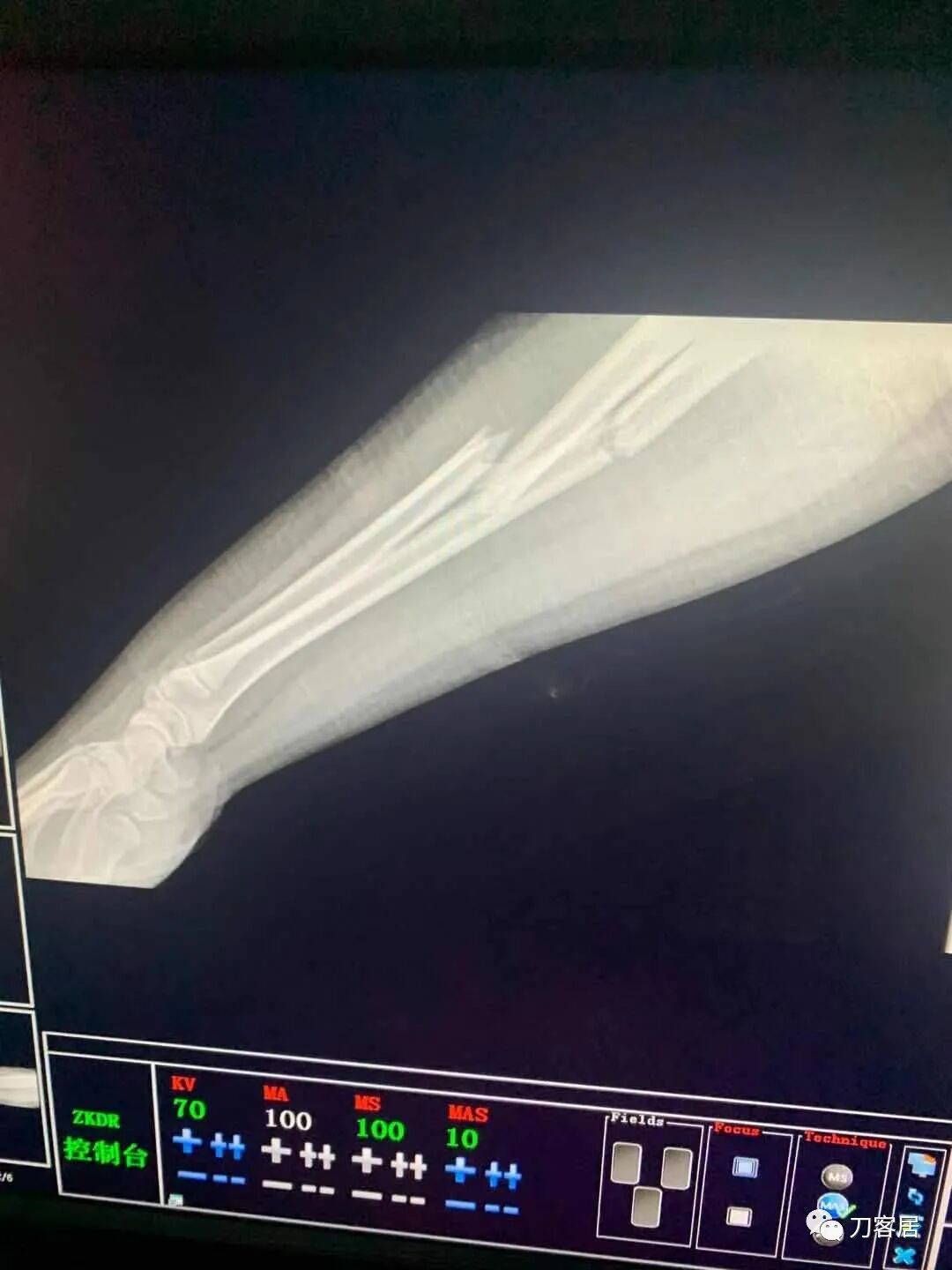 聚酯石膏怎么打6岁孩子的尺桡骨双骨折，就给手术了？外固定架外面还打石膏？_https://www.jmylbn.com_新闻资讯_第70张