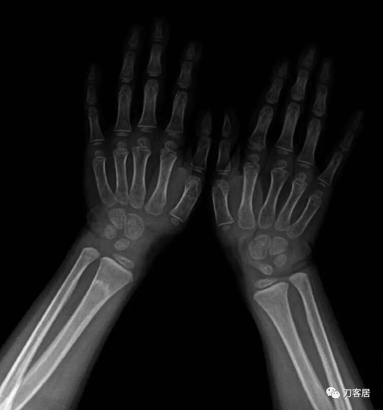 聚酯石膏怎么打6岁孩子的尺桡骨双骨折，就给手术了？外固定架外面还打石膏？_https://www.jmylbn.com_新闻资讯_第67张