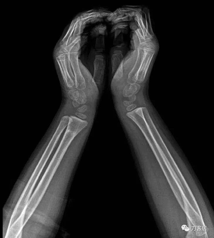 聚酯石膏怎么打6岁孩子的尺桡骨双骨折，就给手术了？外固定架外面还打石膏？_https://www.jmylbn.com_新闻资讯_第68张