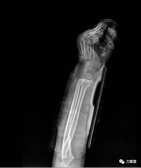 聚酯石膏怎么打6岁孩子的尺桡骨双骨折，就给手术了？外固定架外面还打石膏？_https://www.jmylbn.com_新闻资讯_第63张