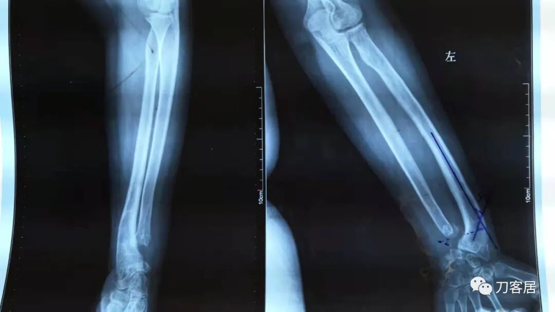 聚酯石膏怎么打6岁孩子的尺桡骨双骨折，就给手术了？外固定架外面还打石膏？_https://www.jmylbn.com_新闻资讯_第22张