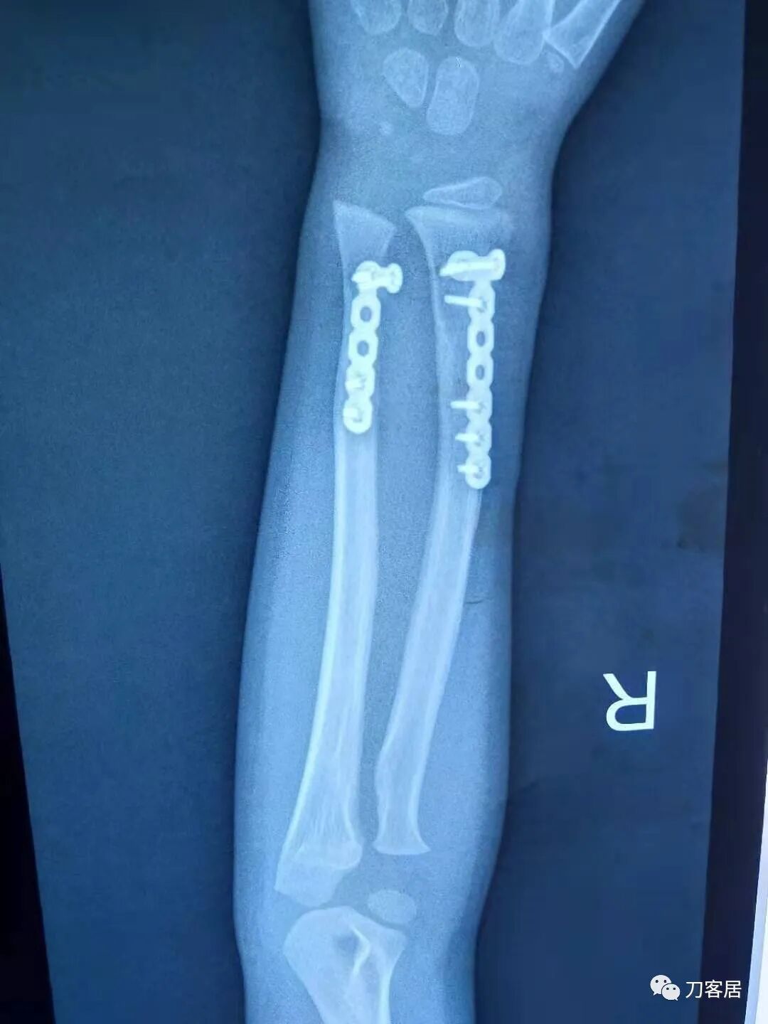 聚酯石膏怎么打6岁孩子的尺桡骨双骨折，就给手术了？外固定架外面还打石膏？_https://www.jmylbn.com_新闻资讯_第14张