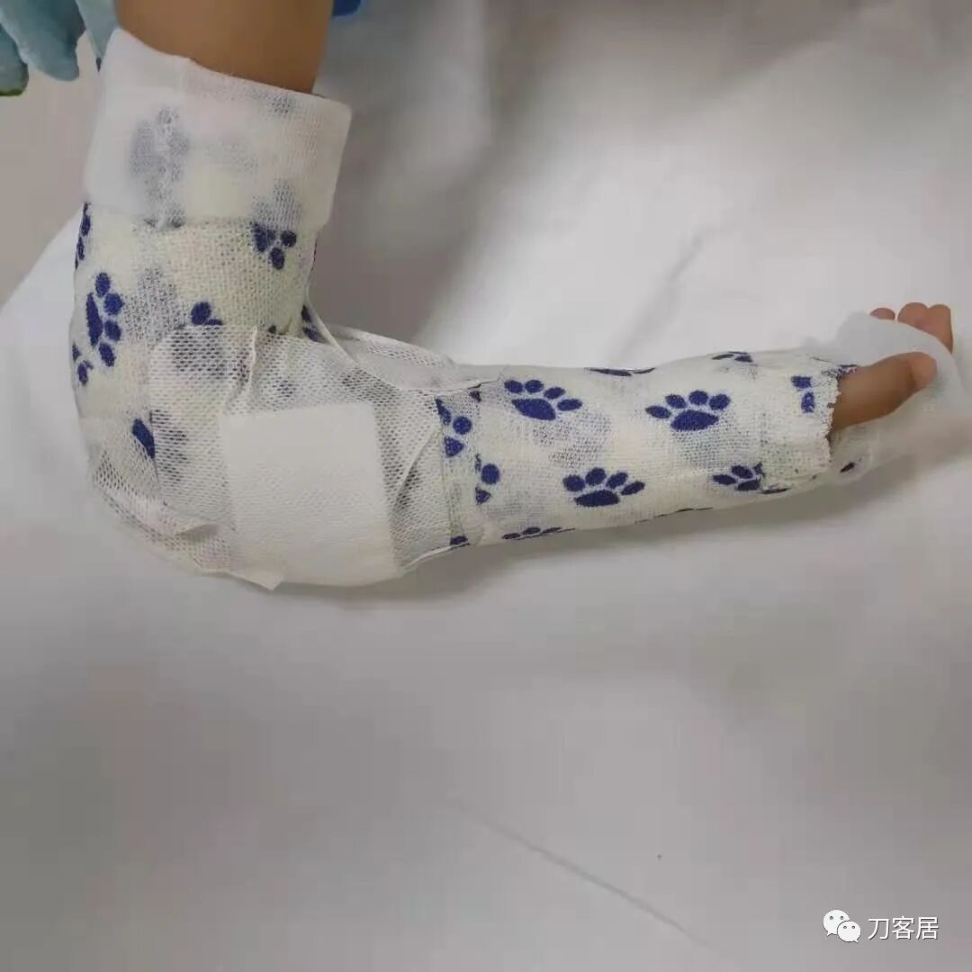 聚酯石膏怎么打6岁孩子的尺桡骨双骨折，就给手术了？外固定架外面还打石膏？_https://www.jmylbn.com_新闻资讯_第17张