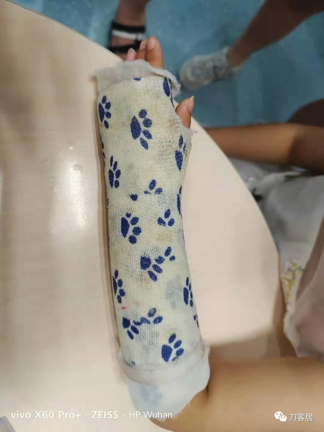 聚酯石膏怎么打6岁孩子的尺桡骨双骨折，就给手术了？外固定架外面还打石膏？_https://www.jmylbn.com_新闻资讯_第21张