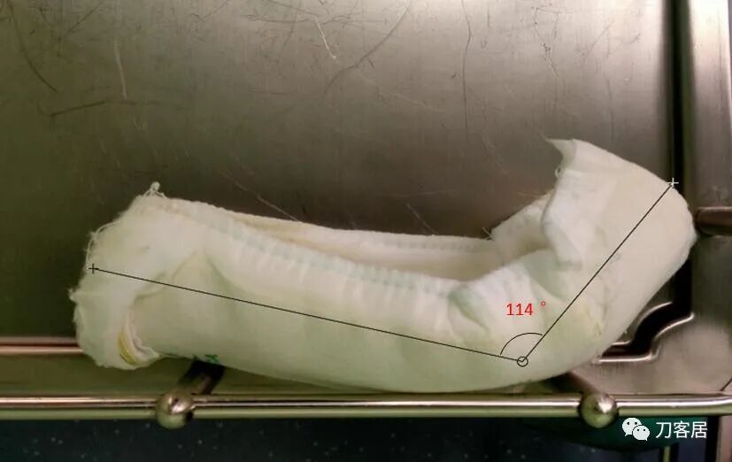 聚酯石膏怎么打6岁孩子的尺桡骨双骨折，就给手术了？外固定架外面还打石膏？_https://www.jmylbn.com_新闻资讯_第16张