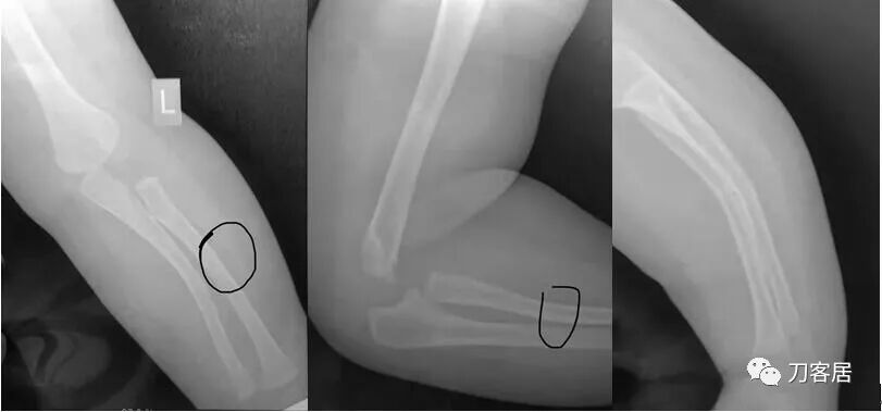 聚酯石膏怎么打6岁孩子的尺桡骨双骨折，就给手术了？外固定架外面还打石膏？_https://www.jmylbn.com_新闻资讯_第15张