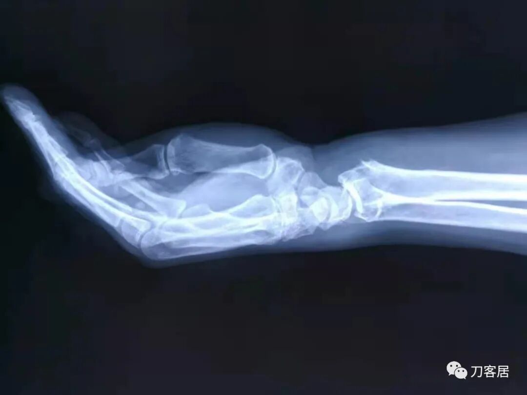 聚酯石膏怎么打6岁孩子的尺桡骨双骨折，就给手术了？外固定架外面还打石膏？_https://www.jmylbn.com_新闻资讯_第55张