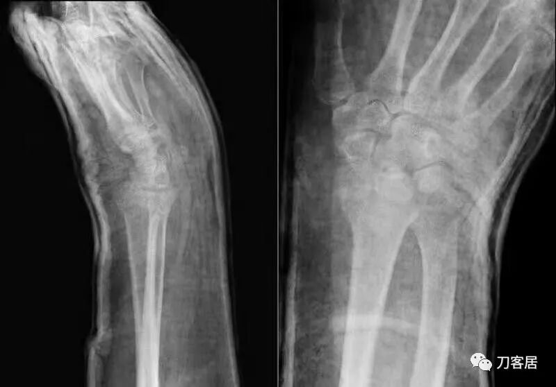 聚酯石膏怎么打6岁孩子的尺桡骨双骨折，就给手术了？外固定架外面还打石膏？_https://www.jmylbn.com_新闻资讯_第50张