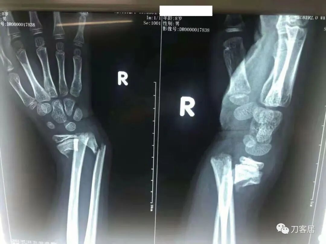 聚酯石膏怎么打6岁孩子的尺桡骨双骨折，就给手术了？外固定架外面还打石膏？_https://www.jmylbn.com_新闻资讯_第29张