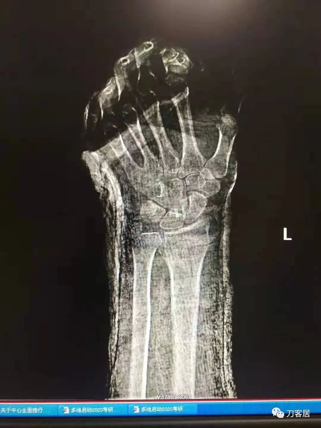 聚酯石膏怎么打6岁孩子的尺桡骨双骨折，就给手术了？外固定架外面还打石膏？_https://www.jmylbn.com_新闻资讯_第56张