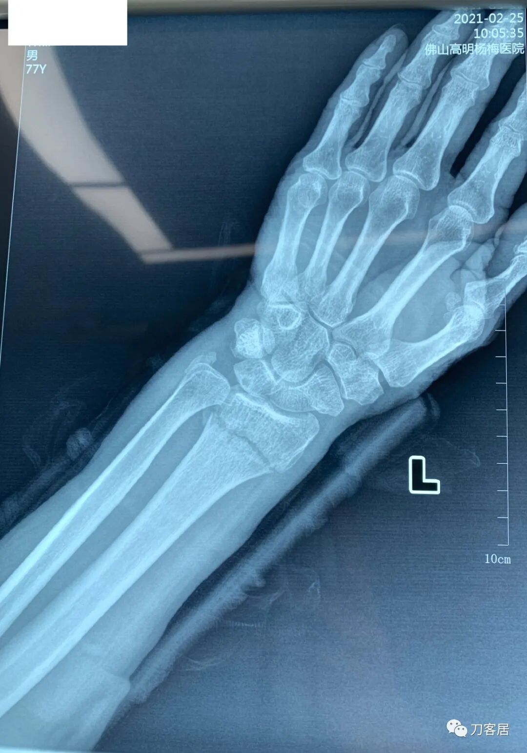 聚酯石膏怎么打6岁孩子的尺桡骨双骨折，就给手术了？外固定架外面还打石膏？_https://www.jmylbn.com_新闻资讯_第35张