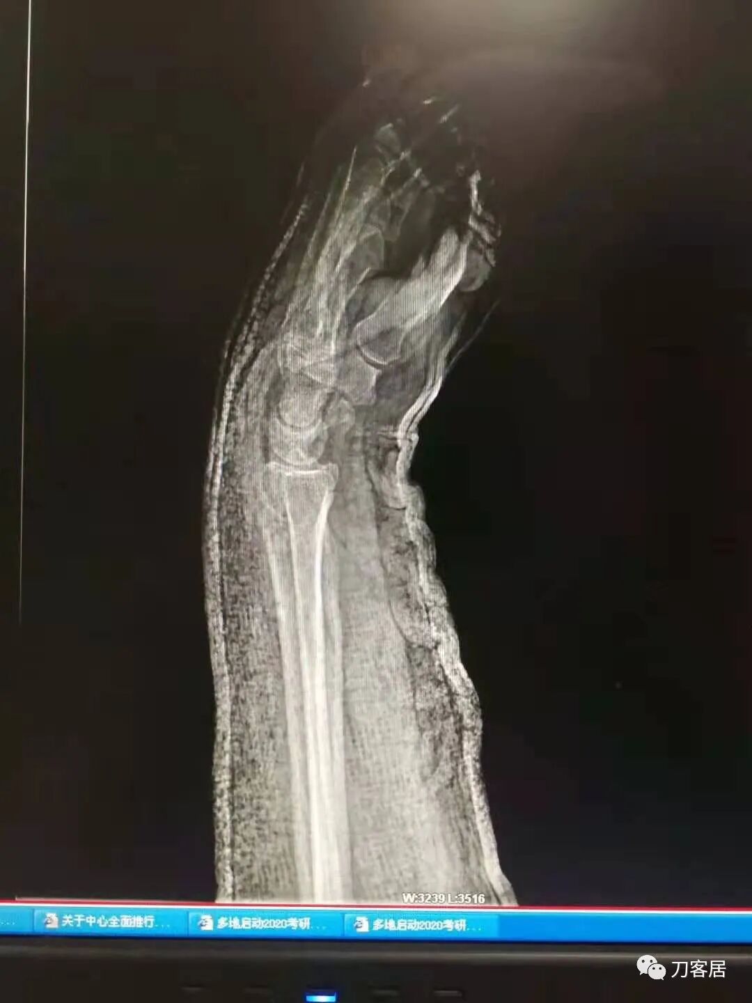 聚酯石膏怎么打6岁孩子的尺桡骨双骨折，就给手术了？外固定架外面还打石膏？_https://www.jmylbn.com_新闻资讯_第57张