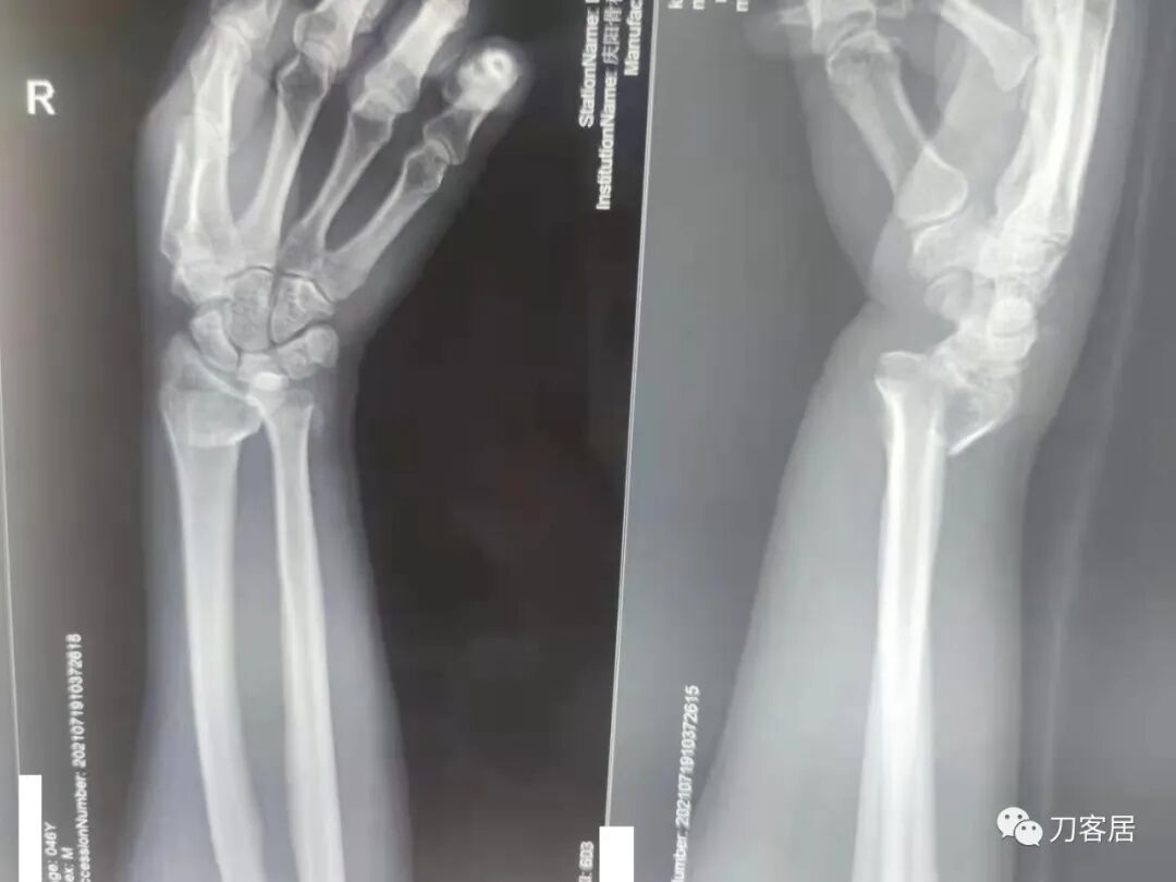聚酯石膏怎么打6岁孩子的尺桡骨双骨折，就给手术了？外固定架外面还打石膏？_https://www.jmylbn.com_新闻资讯_第41张